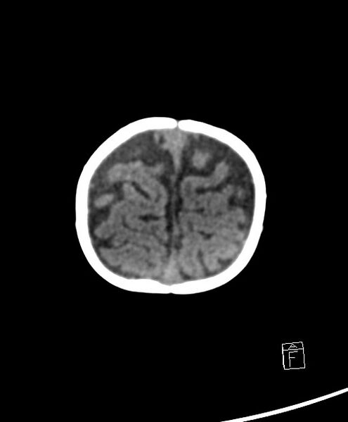 File:Benign enlargement of subarachnoid spaces in infancy (BESS) (Radiopaedia 87459-103795 Axial non-contrast 10).jpg