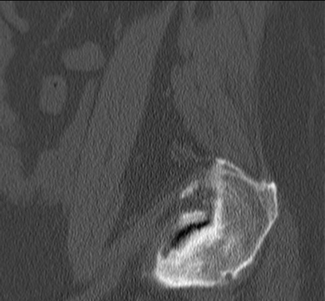 File:Bertolotti syndrome (Radiopaedia 24864-25128 Sagittal bone window 6).jpg