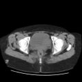 Bicornuate uterus- on MRI (Radiopaedia 49206-54296 Axial non-contrast 12).jpg