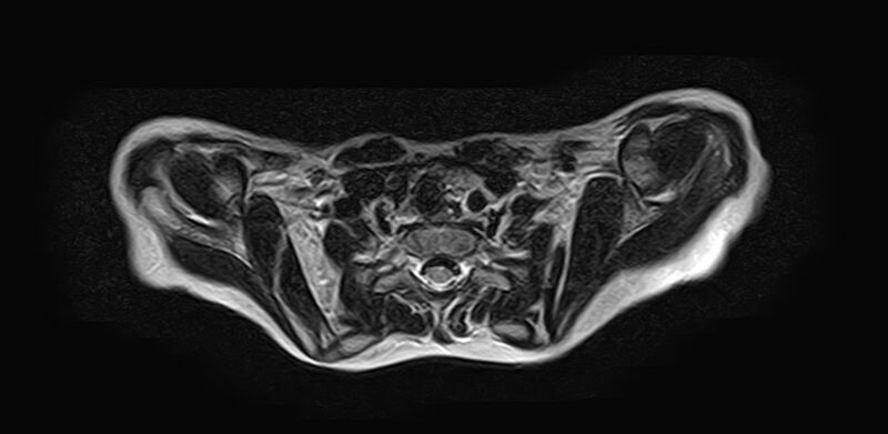 File:Bilateral Sprengel deformity with Klippel-Feil syndrome (Radiopaedia 66395-75650 Axial T2 19).jpg