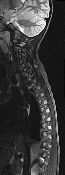 File:Bilateral Sprengel deformity with Klippel-Feil syndrome (Radiopaedia 66395-75650 Sagittal STIR 3).jpg