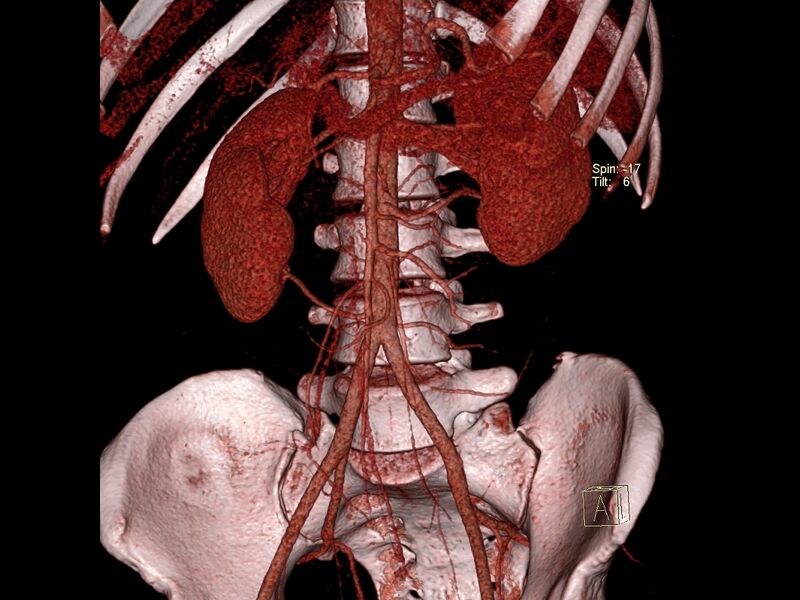 File:Bilateral accessory renal arteries with mild pelvi-ureteric junction (PUJ) obstruction (Radiopaedia 66357-75596 C 2).jpg