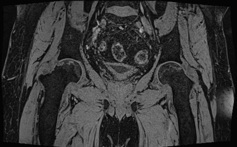 File:Bilateral avascular necrosis of femoral head (Radiopaedia 77116-89078 Coronal T2 we 34).jpg