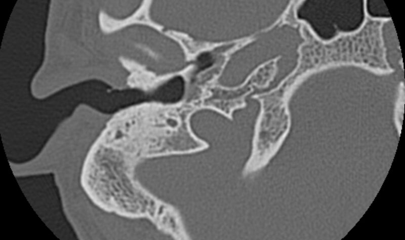 File:Bilateral cholesteatoma (Radiopaedia 54898-61172 Axial bone window 8).jpg