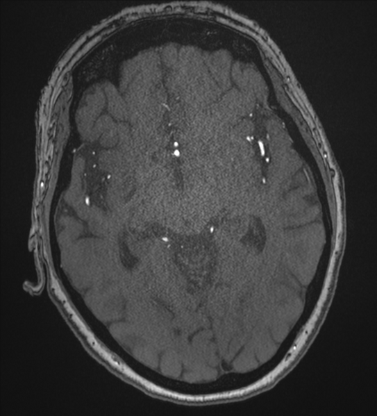 File:Bilateral fetal posterior communicating arteries (Radiopaedia 41286-44102 Axial MRA 97).png
