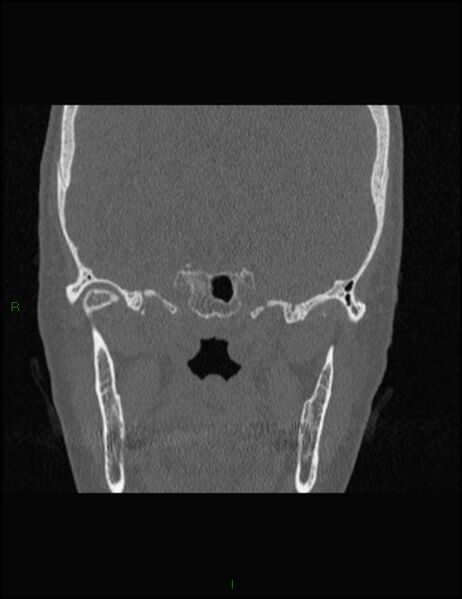 File:Bilateral frontal mucoceles (Radiopaedia 82352-96454 Coronal 262).jpg