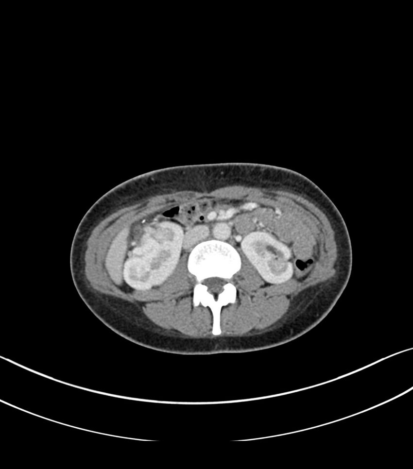 Bilateral kidney malrotation (Radiopaedia 72227-82749 A 26).jpg