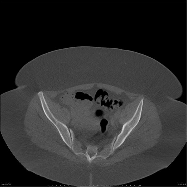 File:Bilateral lumbar ribs (Radiopaedia 25862-26010 bone window 53).jpg