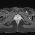 Bilateral ovarian endometriomas (Radiopaedia 87085-103347 Axial T1 C+ fat sat 22).jpg