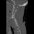 Bilateral perched facets with cord injury (Radiopaedia 45587-49713 Sagittal bone window 20).jpg