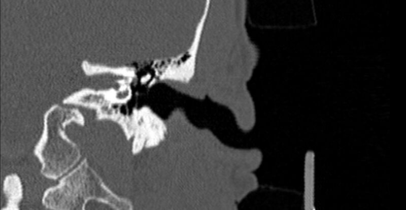 File:Bilateral temporal bone fractures (Radiopaedia 29482-29970 Coronal 235).jpg