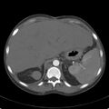 Biliary necrosis - liver transplant (Radiopaedia 21876-21846 A 16).jpg