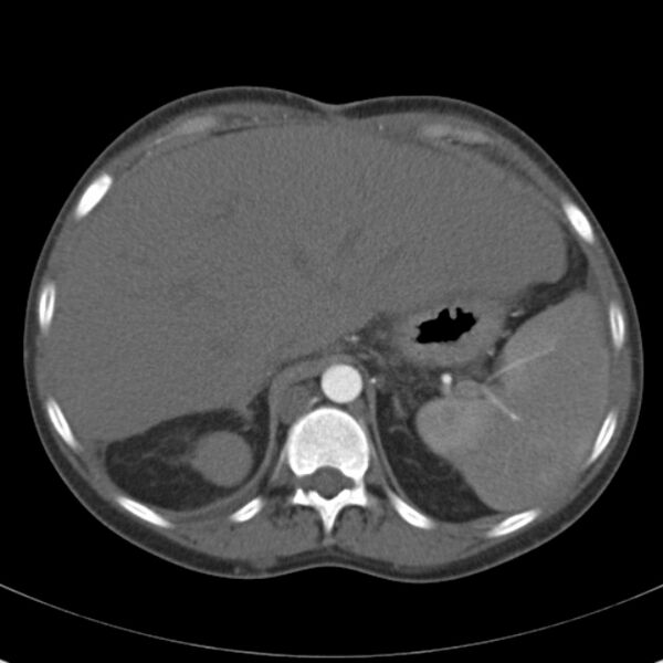 File:Biliary necrosis - liver transplant (Radiopaedia 21876-21846 A 16).jpg