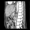 Biliary necrosis - liver transplant (Radiopaedia 21876-21846 D 4).jpg
