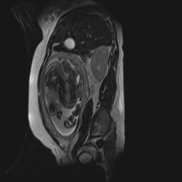 File:Bilobed placenta accreta (Radiopaedia 69648-79591 G 44).jpg