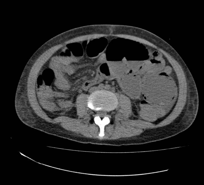 File:Bowel lymphoma complicated by bleeding after therapy (Radiopaedia 55601-62110 Axial non-contrast 46).jpg