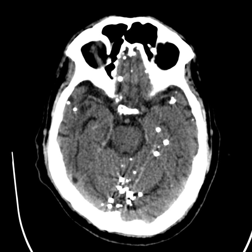 Brain Pantopaque remnants (Radiopaedia 78403-91048 Axial non-contrast 39).jpg