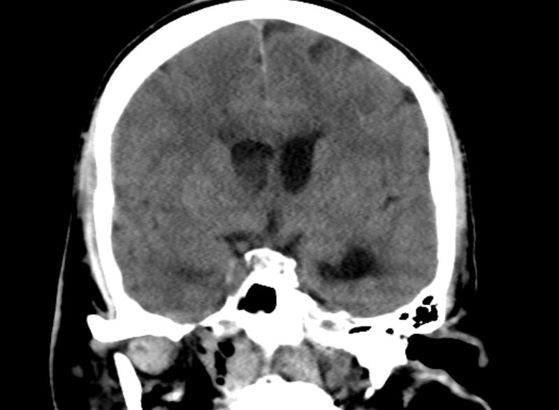 File:Brain abscess complicated by intraventricular rupture and ventriculitis (Radiopaedia 82434-96575 Coronal non-contrast 10).jpg