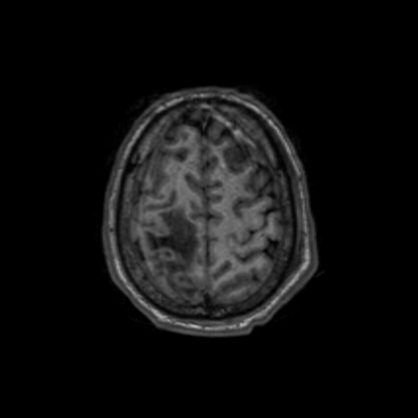 Brain abscess complicated by intraventricular rupture and ventriculitis (Radiopaedia 82434-96577 Axial T1 60).jpg