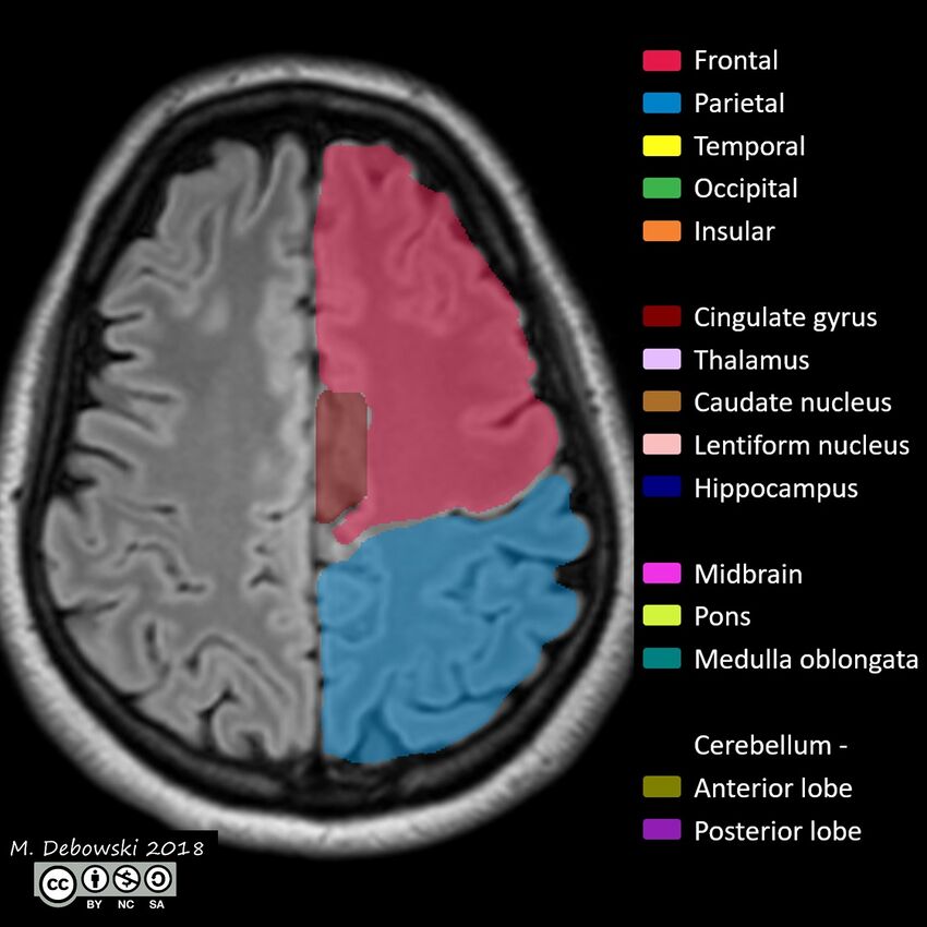 Brain lobes - annotated MRI (Radiopaedia 61691-69700 Axial 19).JPG