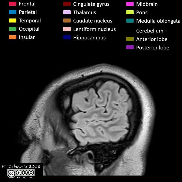 File:Brain lobes - annotated MRI (Radiopaedia 61691-69700 Sagittal 4).JPG