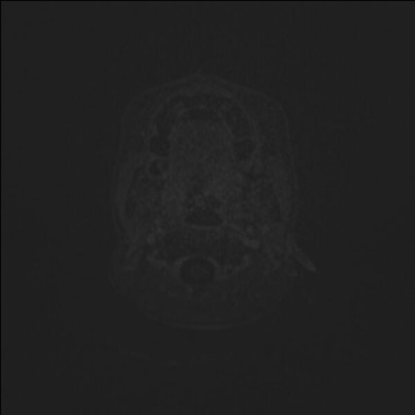 File:Brainstem glioma (Radiopaedia 70548-80674 Axial T1 C+ 1).jpg