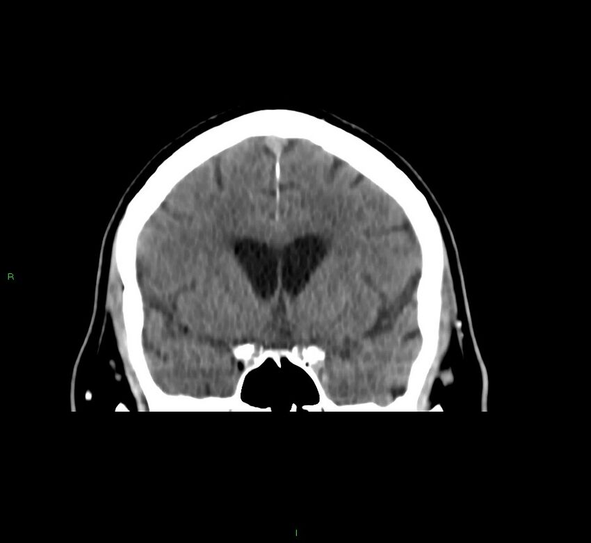 Brainstem hemorrhage (Radiopaedia 58794-66028 Coronal non-contrast 41).jpg
