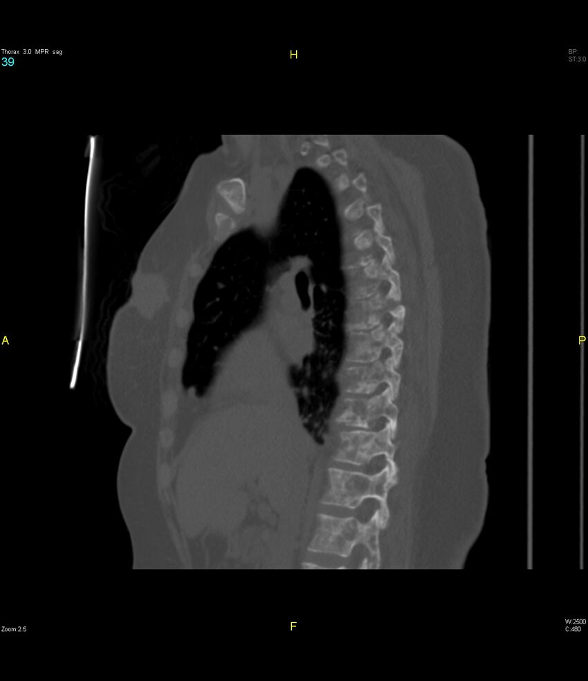 Breast primary with lung and bone metastases (Radiopaedia 40620-43228 Sagittal bone window 39).jpg