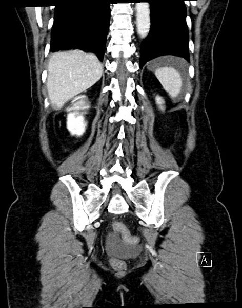 File:Broad ligament hernia (Radiopaedia 84802-100276 B 11).jpg