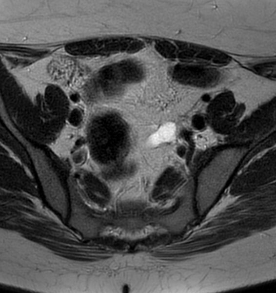 File:Broad ligament leiomyoma (Radiopaedia 81634-95516 Axial T2 7).jpg