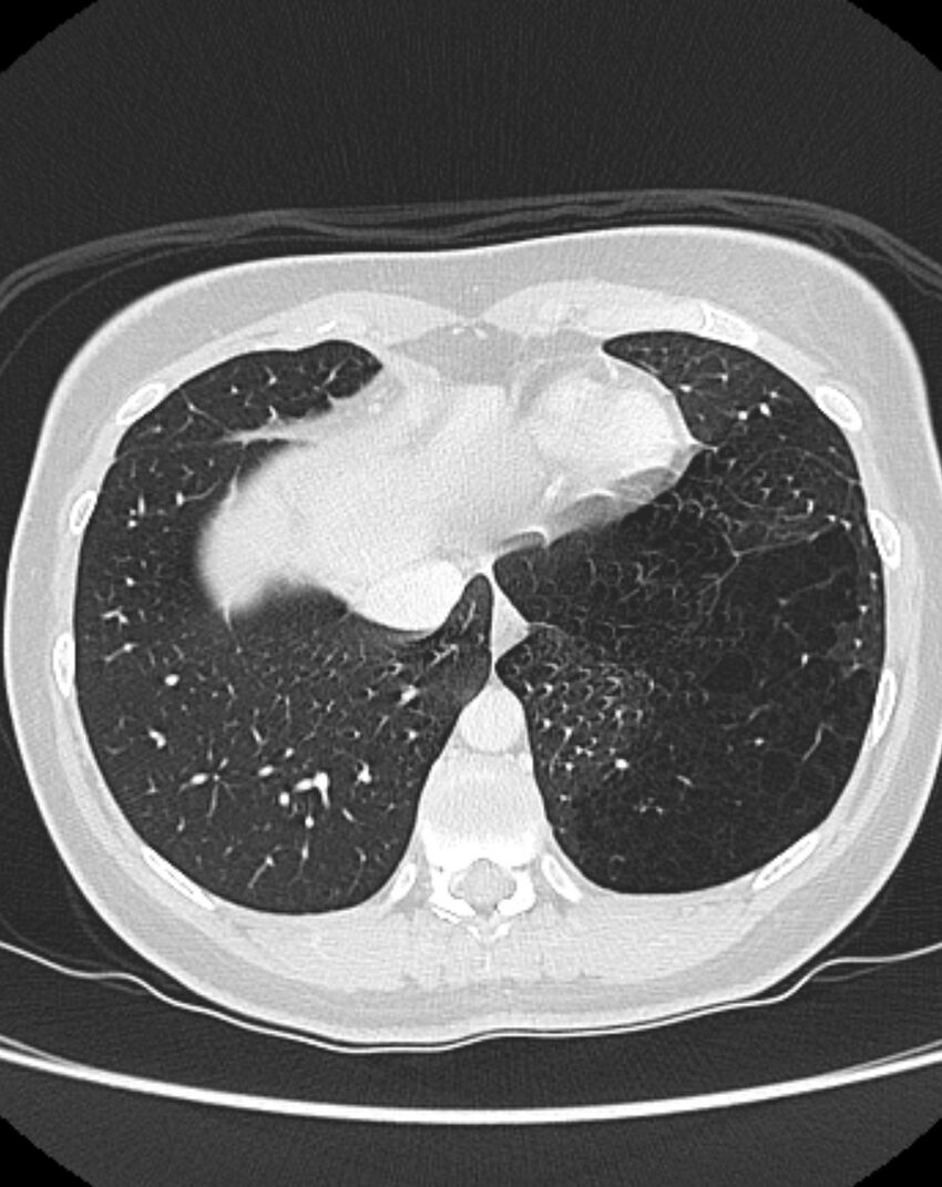 Bronchial atresia (Radiopaedia 50007-55297 Axial lung window 87).jpg