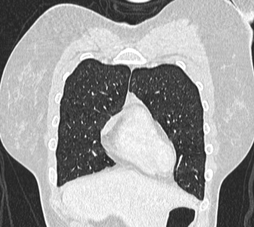 Bronchial atresia (Radiopaedia 50007-55297 Coronal lung window 13).jpg