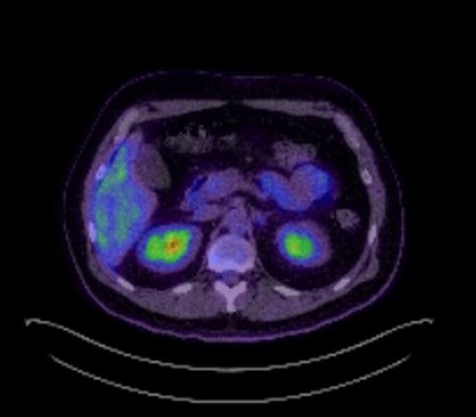File:Bronchial carcinoid tumor (Radiopaedia 67377-76766 18FDG-PET-CT 41).jpg