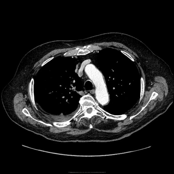 File:Bronchogenic adenocarcinoma and pulmonary embolism (Radiopaedia 9097-9806 D 22).jpg