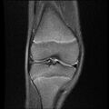 Bucket handle tear - lateral meniscus (Radiopaedia 72124-82634 Coronal PD fat sat 7).jpg