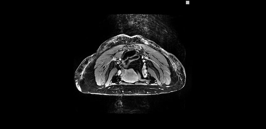 Buttock filler complications (Radiopaedia 63497-72115 Axial T1 C+ 4).jpg