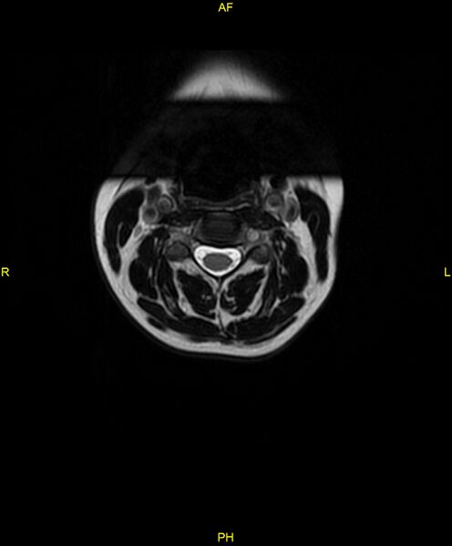 File:C5 nerve sheath tumor (Radiopaedia 85777-101596 Axial T2 11).jpg