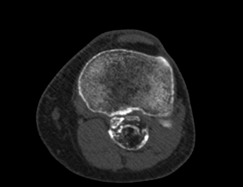 File:Calcified hematoma - popliteal fossa (Radiopaedia 63938-72763 Axial bone window 51).jpg