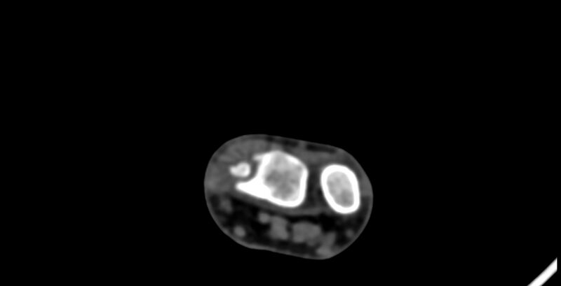 File:Calcifying aponeurotic fibroma (Radiopaedia 88423-105064 B 18).jpg