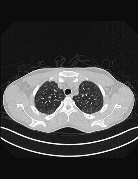 File:Calcifying pulmonary metastases (Radiopaedia 33359-34396 Axial lung window 13).jpg
