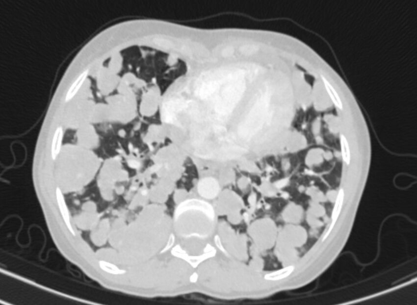 Cannonball metastases from breast cancer (Radiopaedia 91024-108569 Axial lung window 70).jpg