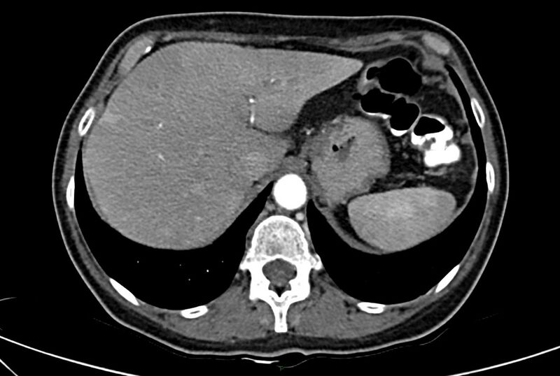 File:Carcinoid mesenteric tumor complicated by chylous ascites (Radiopaedia 76312-88926 A 13).jpg