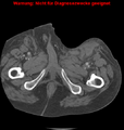 Cardiac perforation following transcatheter aortic valve implantation (Radiopaedia 23714-23863 B 19).png