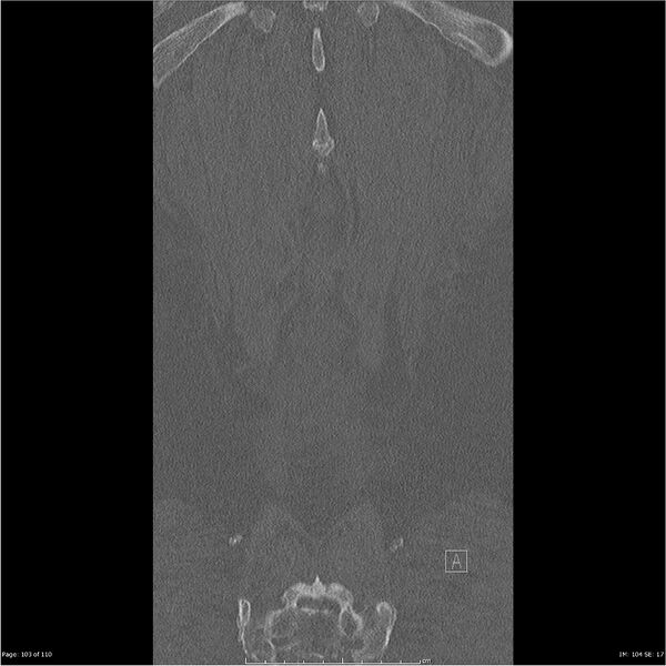 File:Cardiac trauma (Radiopaedia 32874-33858 Coronal bone window 103).jpg