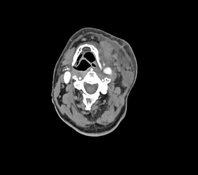 File:Carotid artery pseudoaneurysm (Radiopaedia 84030-99259 C 37).jpg