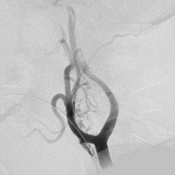 File:Carotid body tumor on angiography (Radiopaedia 4651-6729 A 1).jpg