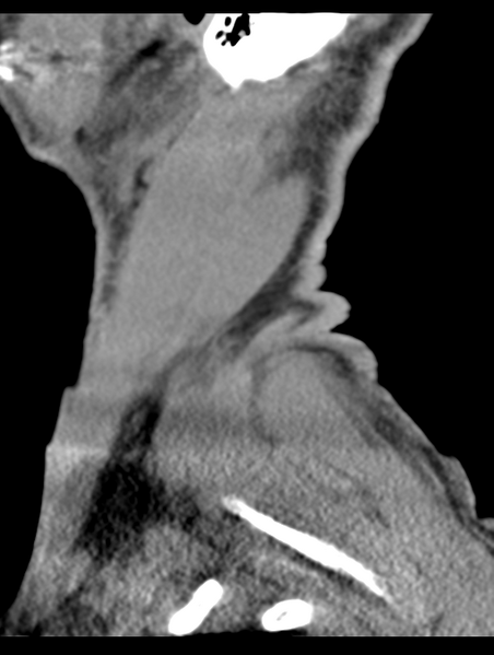 File:Cavernoma of cervical cord (Radiopaedia 50838-56346 B 78).png