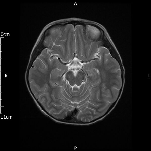 File:Cavernous sinus thrombosis (Radiopaedia 79414-92512 Axial T2 12).jpg