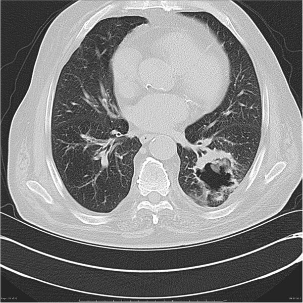 File:Cavitating left lower lobe lesion - squamous cell lung cancer (Radiopaedia 27749-28176 Axial lung window 30).jpg