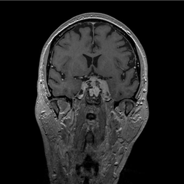 File:Central base of skull meningioma (Radiopaedia 53531-59549 Coronal T1 C+ 12).jpg